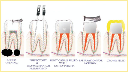 root canal treatment image